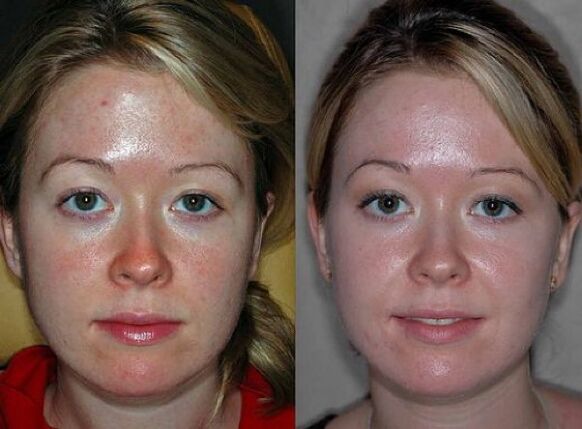 Before and after photos of plasma rejuvenation procedure
