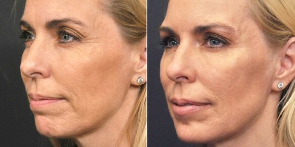 Before and after photos of plasma rejuvenation