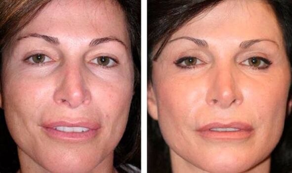 post plasma facial skin rejuvenation photo