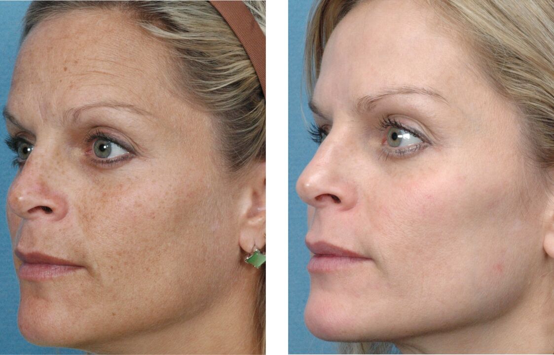 Photo 1 before and after skin rejuvenation