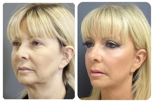 2 before and after skin rejuvenation with tightening photo
