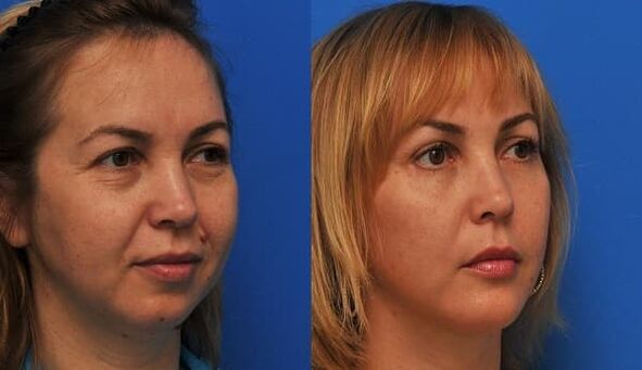 Before and after skin rejuvenation with tightening photo