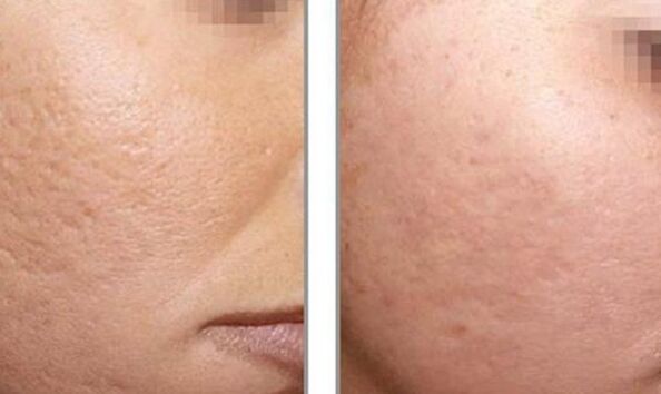 Before and after photo of laser rejuvenation