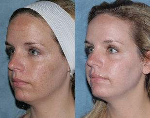 In the photo, before and after-fractional face rejuvenation