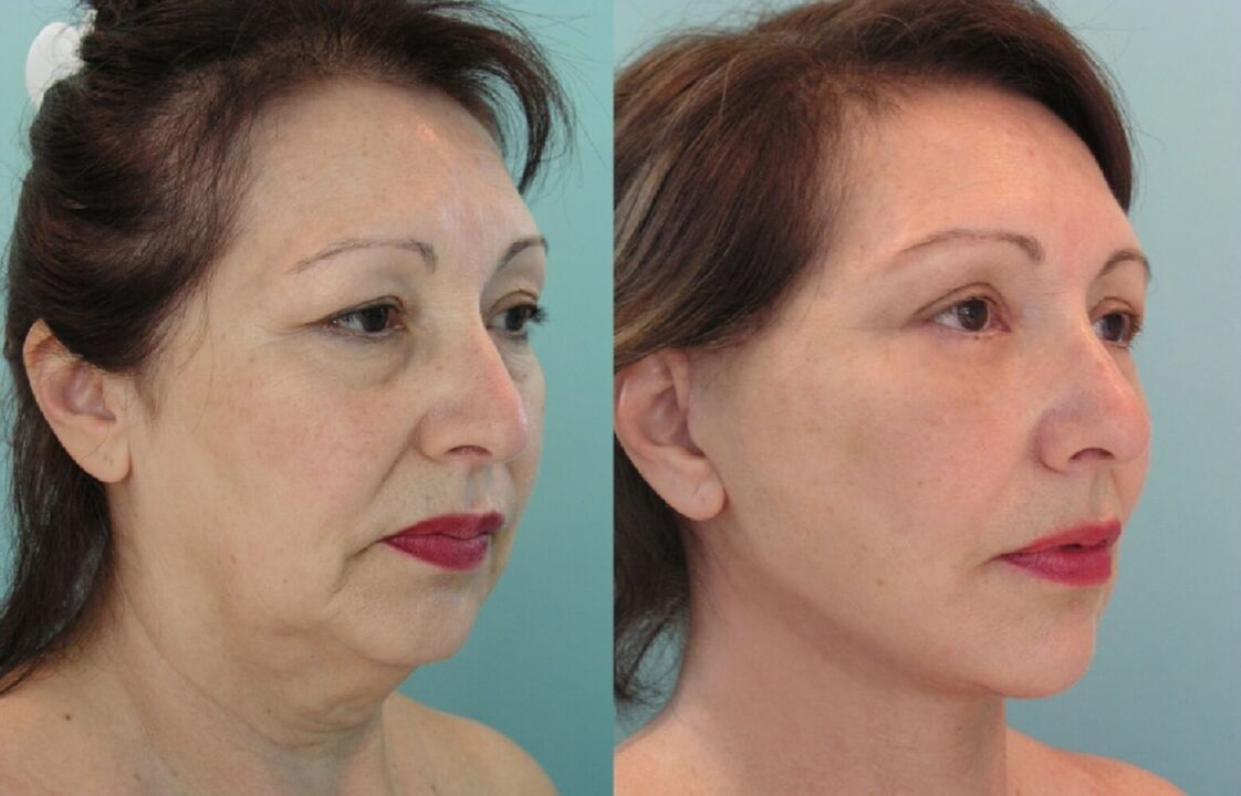Thread facelift before and after